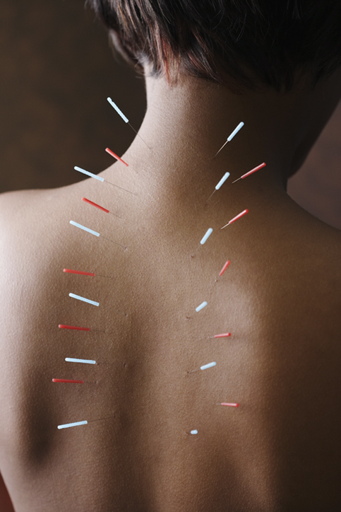 Acupuncture needles in woman's back
